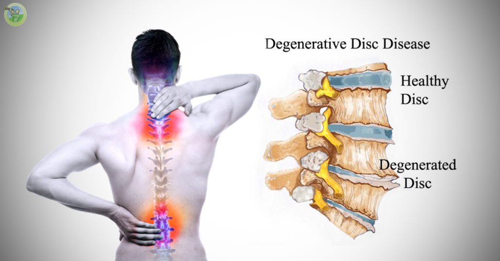 Degenerative Disc Disease