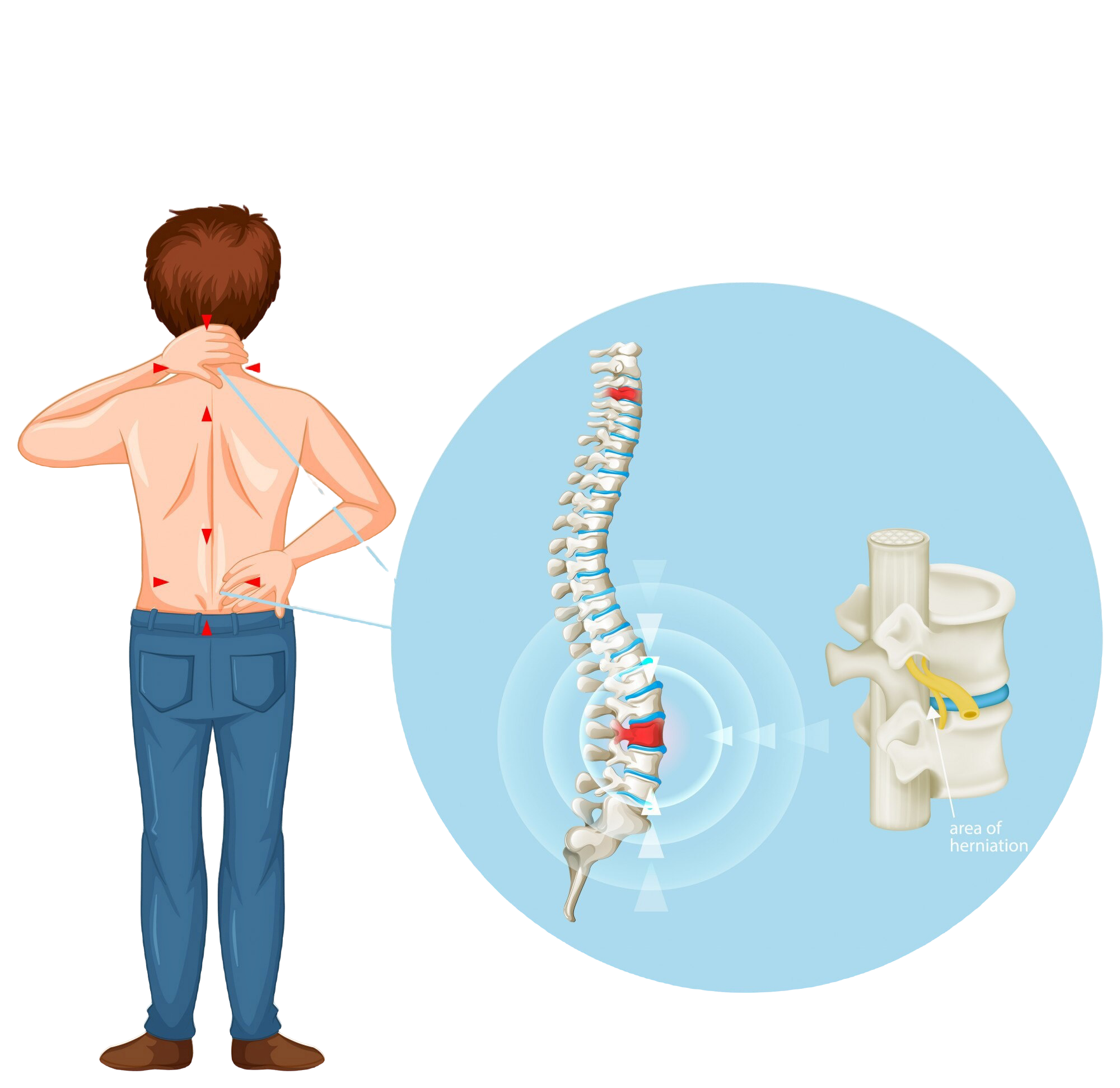 Herniated Disc