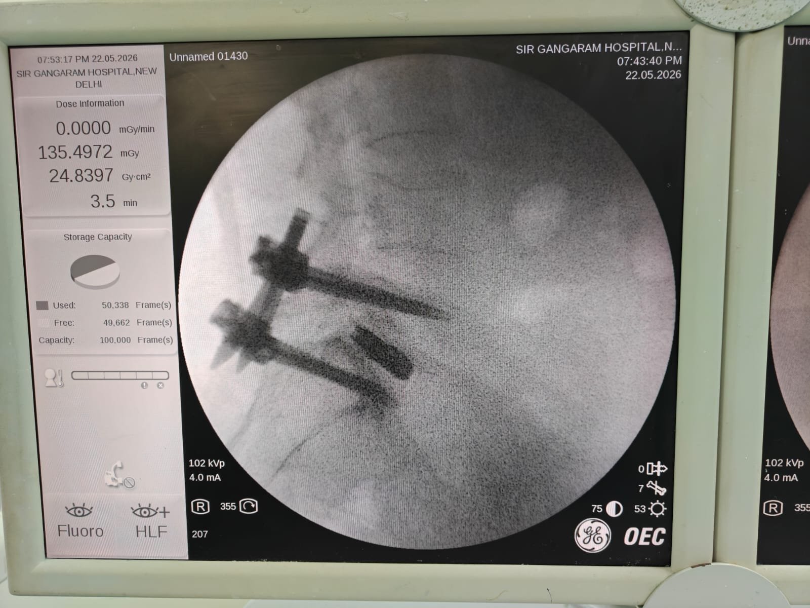 Monitor Endoscopic Discectomy