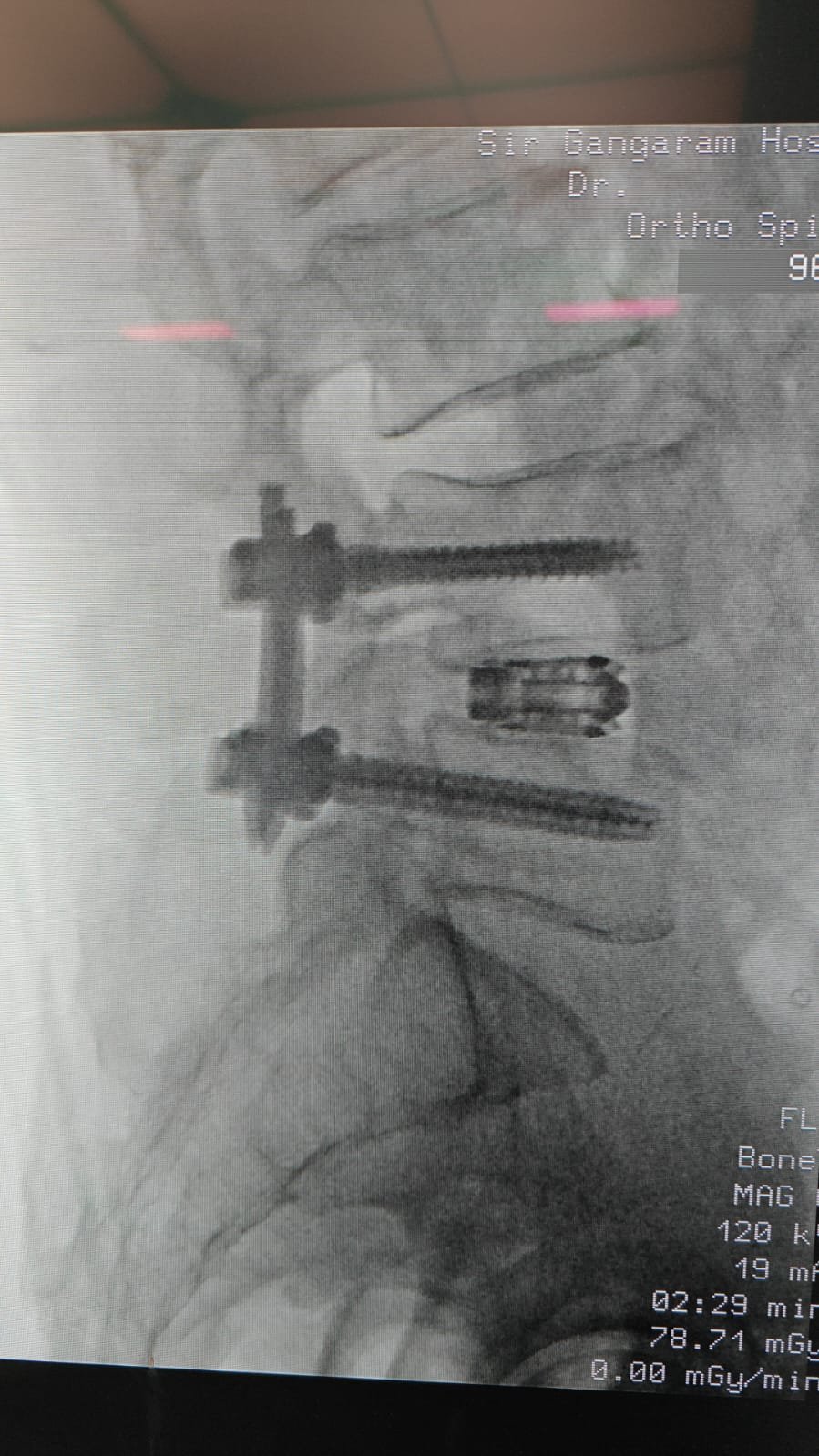 MISS TLIF X-Ray