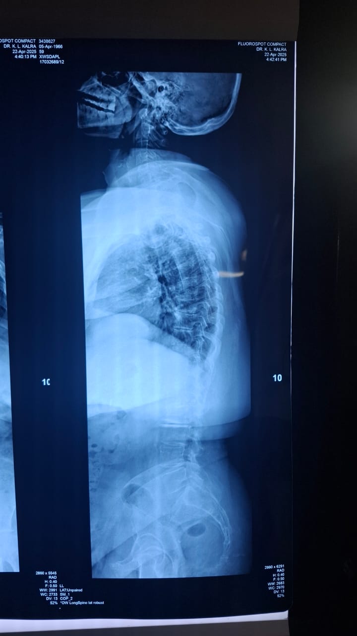 Oblique Lateral Interbody Fusion (OLIF) Surgery In Delhi