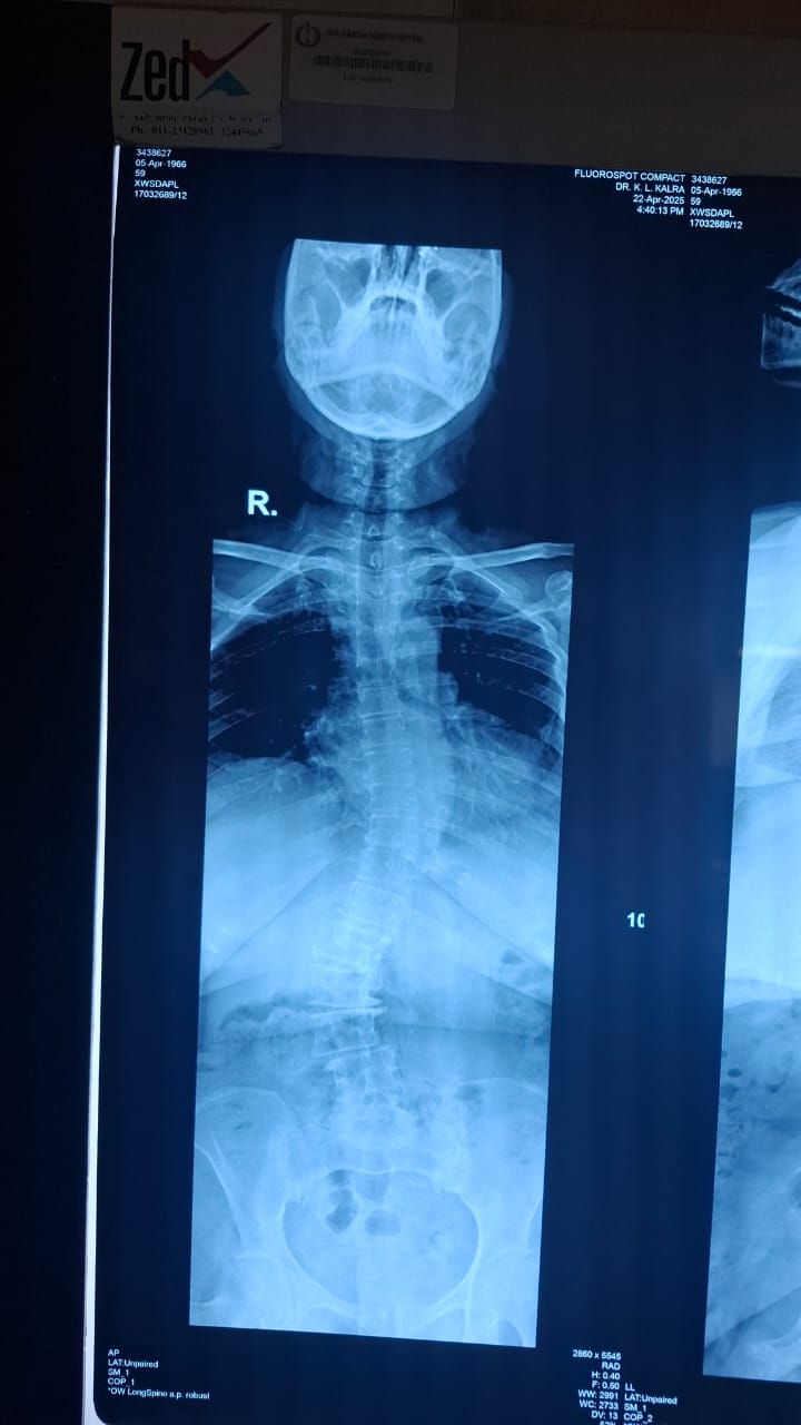 Oblique Lateral Interbody Fusion (OLIF) Surgery In Delhi
