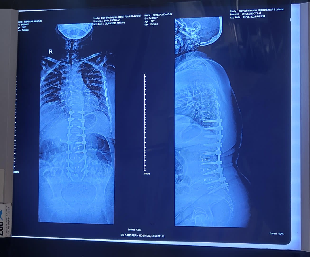 Oblique Lateral Interbody Fusion (OLIF) Surgery In Delhi