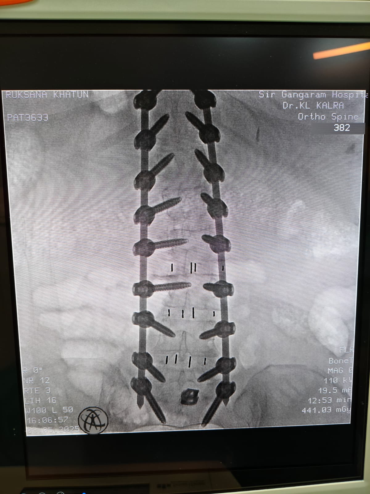 Oblique Lateral Interbody Fusion (OLIF) Surgery In Delhi