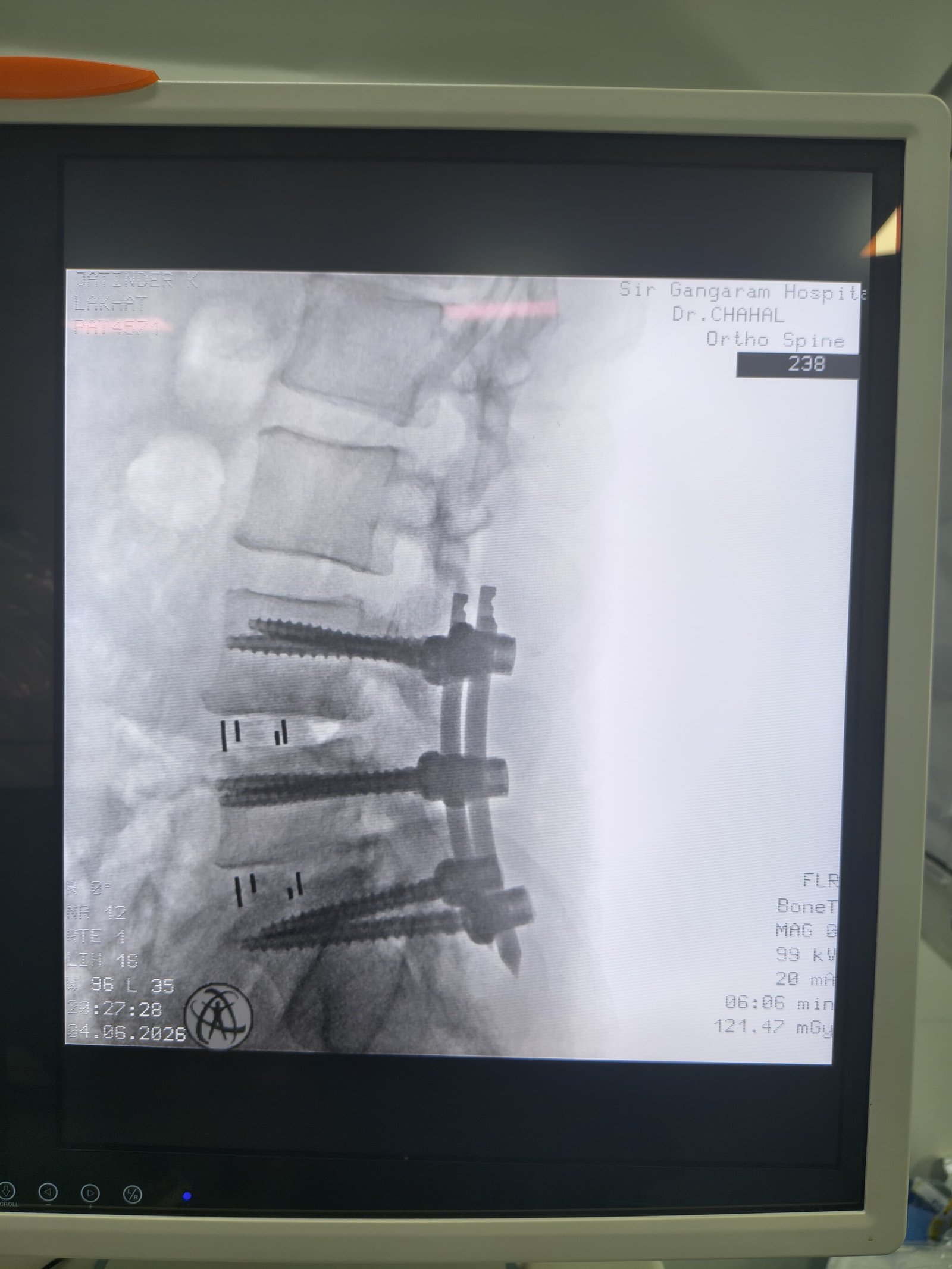 OLIF X-Ray