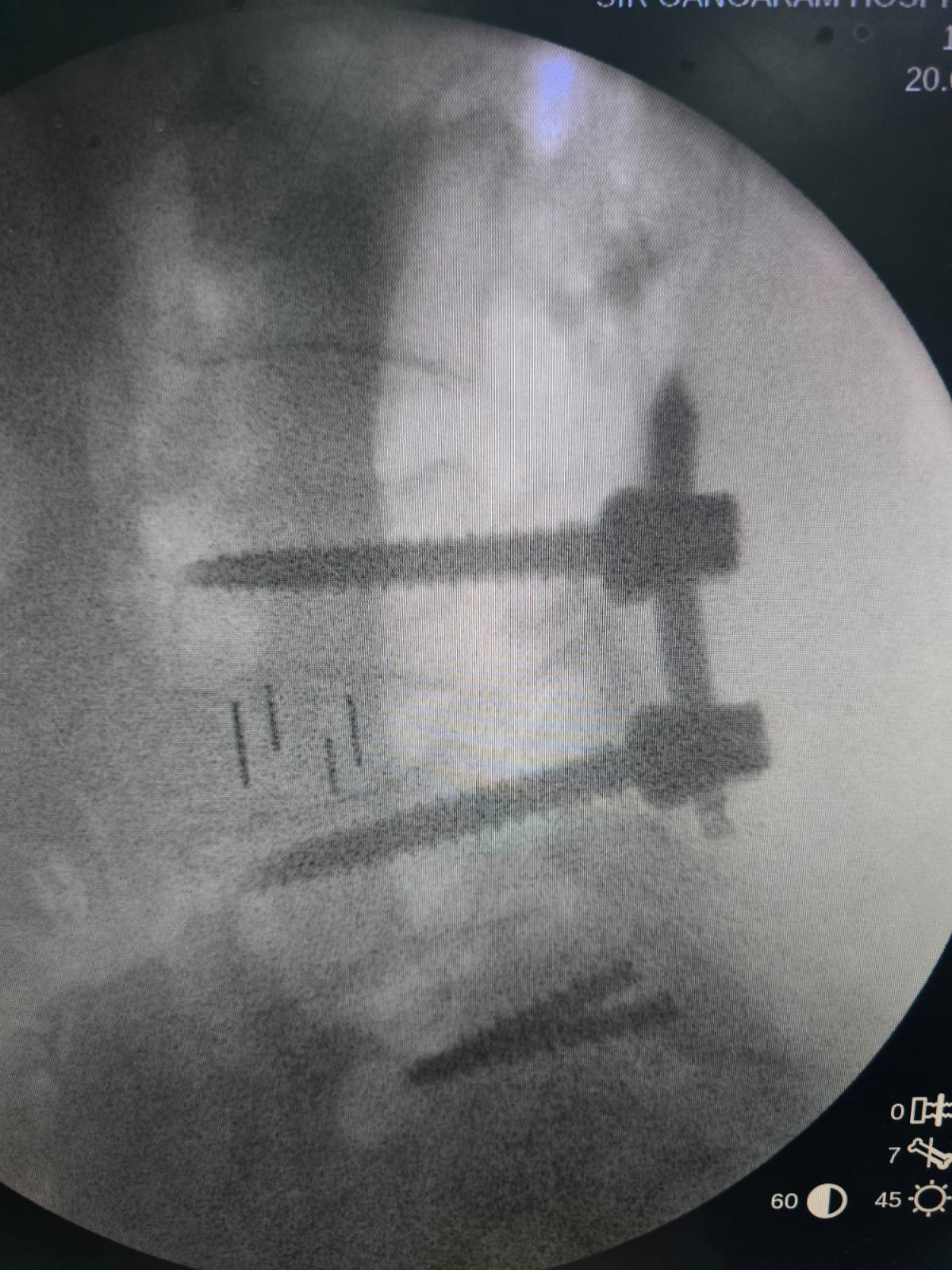 Revision Spine Surgery