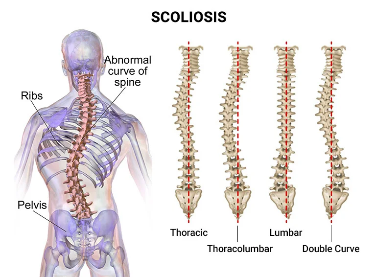 Scoliosis