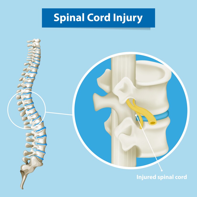 Spinal Cord Injuries