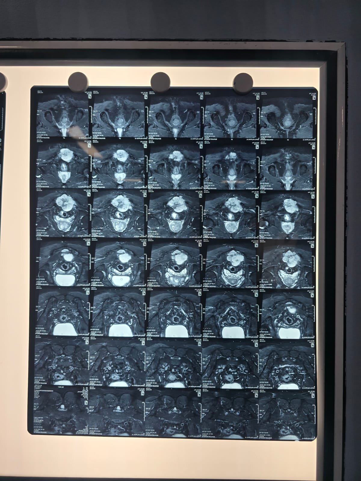 Tumor Surgery Scan