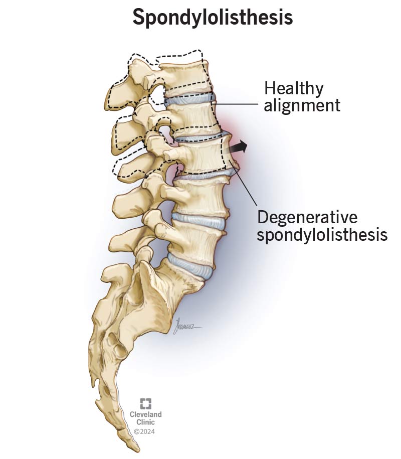 Spondylolisthesis